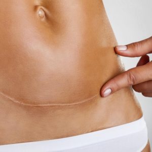 Can I get rid of my pooch tummy after a c-section?